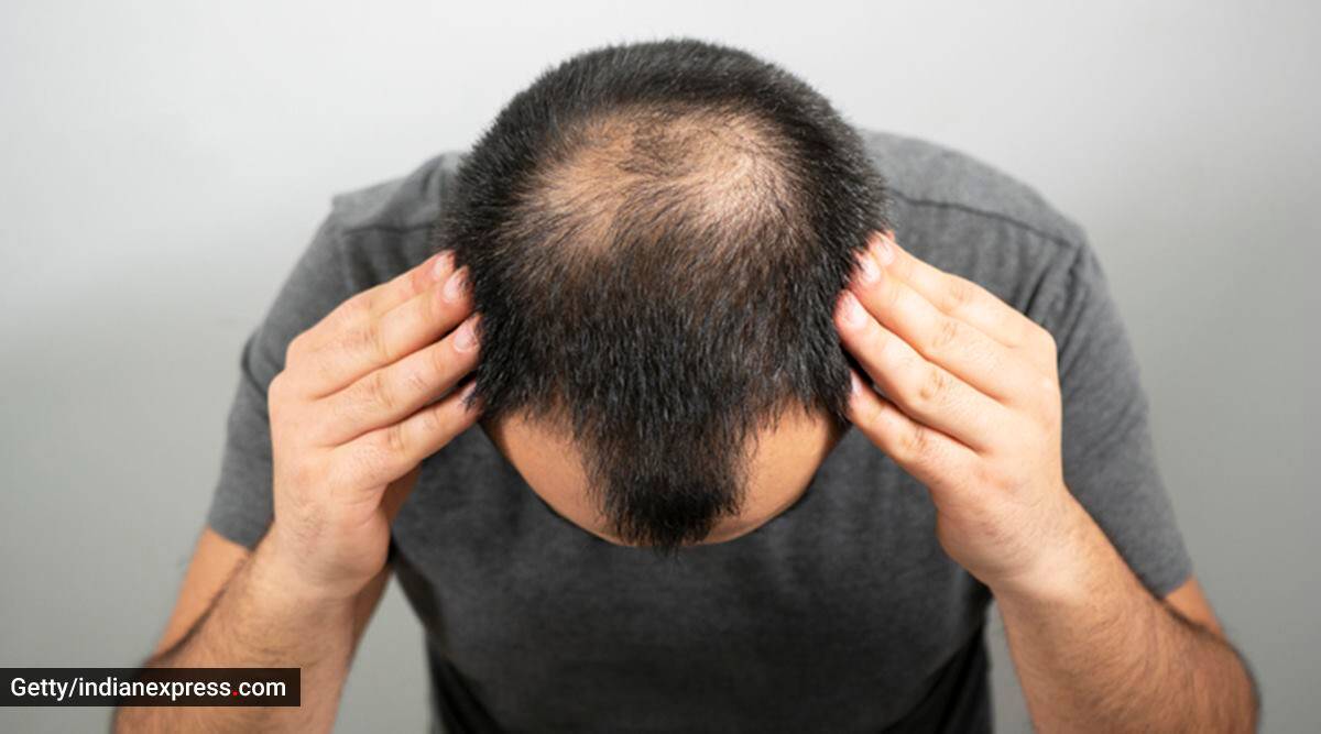 5 Reasons Why You Should Consider a Hair Transplant